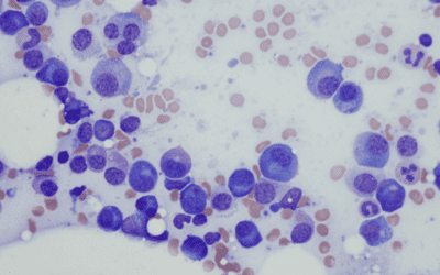 Microscopic image of a slide demonstrating multiple myeloma from bone marrow aspirate.