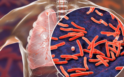 Transparent lungs with a granuloma in the upper left corner. Over the lungs is a zoomed in image of the granuloma displaying Mycobacterium tuberculosis, rod-shaped bacteria.