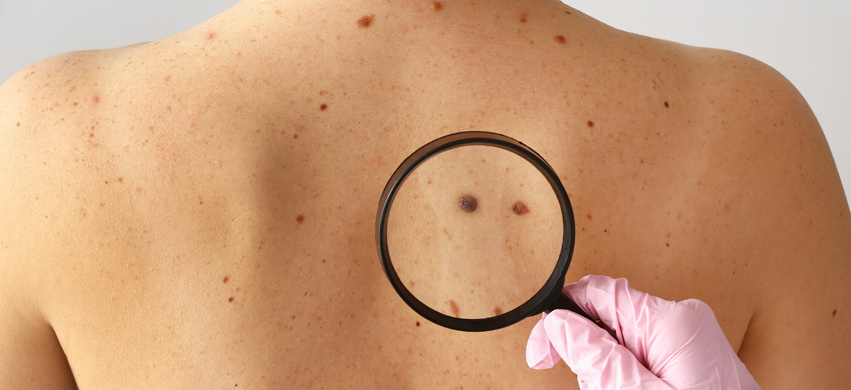 A gloved hand holding a magnifying glass to inspect possible melanoma